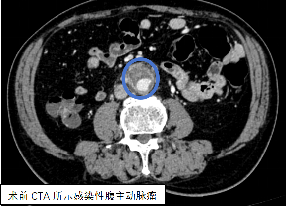 腹主动脉瘤，随时可能破裂！仁济专家“拆弹+重建”，巧手复原腹主动脉(3)328.png